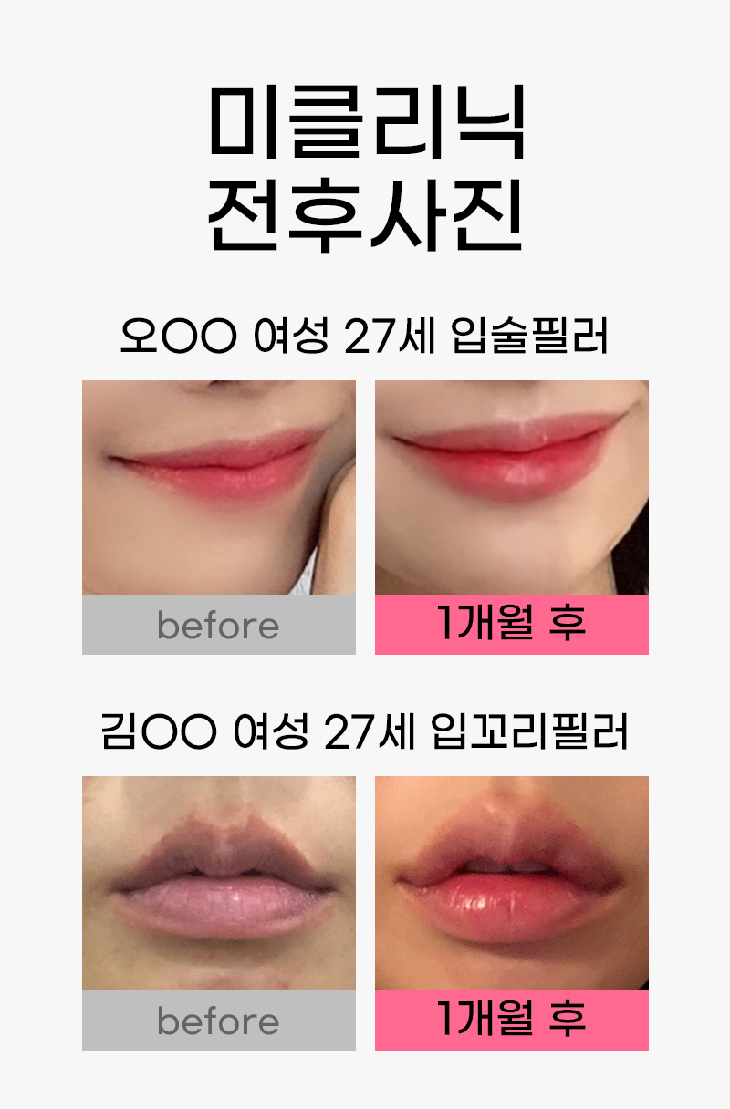 입술필러 after&before